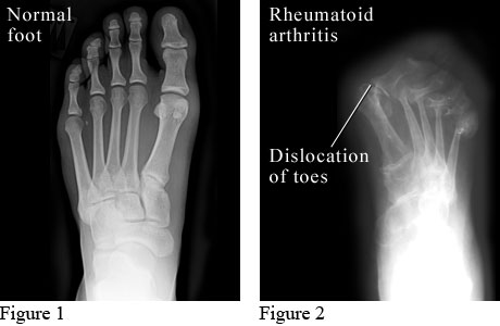 x-ray ke atas pesakit normal dan pesakit rheumatoid arthritis