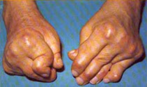 rheumatoid arthritis affecting hands